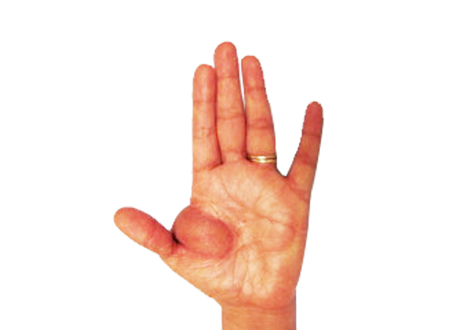 Soft Tissue Defects of Hand 